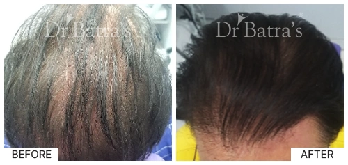 Hair Falling Treatment